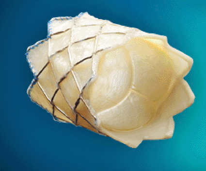 Image: The Melody Transcatheter Pulmonary Valve Therapy (photo courtesy Medtronic).
